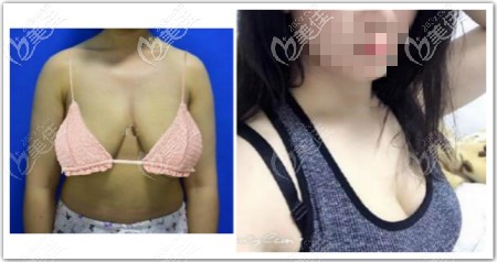 胸小外擴下垂厲害還軟做假體隆胸矯正效果圖片