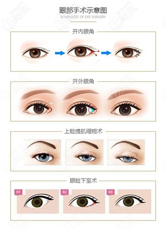 眼綜合手術(shù)項(xiàng)目