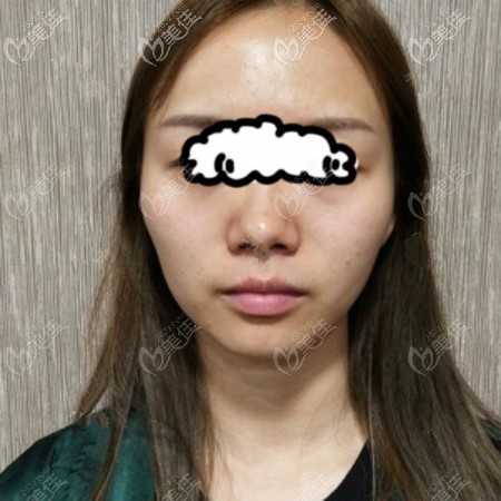 做肋骨鼻加膨體鼻綜合手術(shù)前鼻子樣子 做肋骨鼻加膨體鼻綜合手術(shù)前鼻子樣子