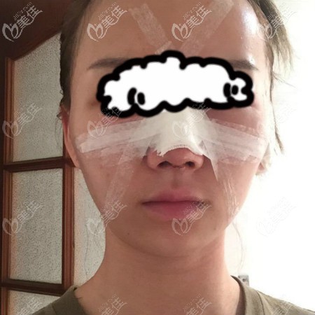 我找武漢美基元汪福強做鼻子術(shù)后第3天 我找武漢美基元汪福強做鼻子術(shù)后第3天