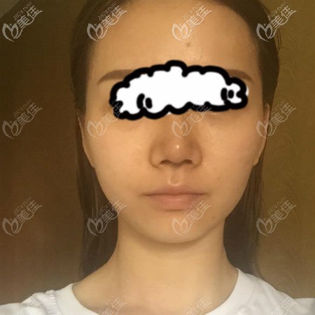 美基元汪福強給我做肋骨鼻綜合術(shù)后十天效果圖片 美基元汪福強給我做肋骨鼻綜合術(shù)后十天效果圖片