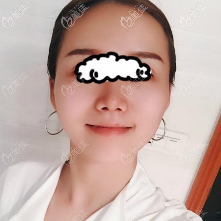 我在武漢美基元做肋骨鼻綜合手術(shù)2個月效果圖片 我在武漢美基元做肋骨鼻綜合手術(shù)2個月效果圖片