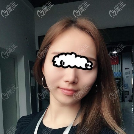 全面對(duì)比后,在武漢美基元找汪福強(qiáng)醫(yī)生做了肋骨鼻加膨體隆鼻綜合手術(shù)