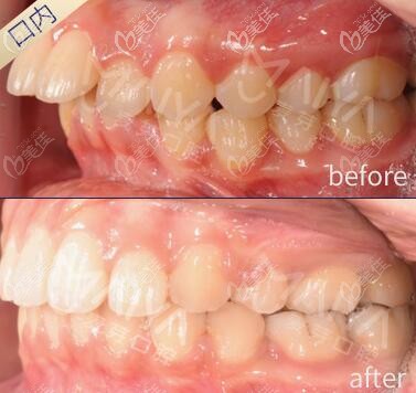 秀下我在廈門麥芽口腔戴隱適美透明牙套矯正上門牙前突滴效果