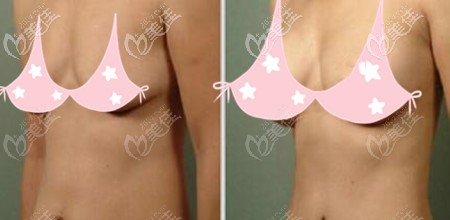 假體隆胸后效果對比