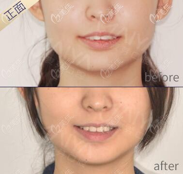 我在廈門麥芽口腔戴隱適美牙套前后臉型變化圖 我在廈門麥芽口腔戴隱適美牙套前后臉型變化圖