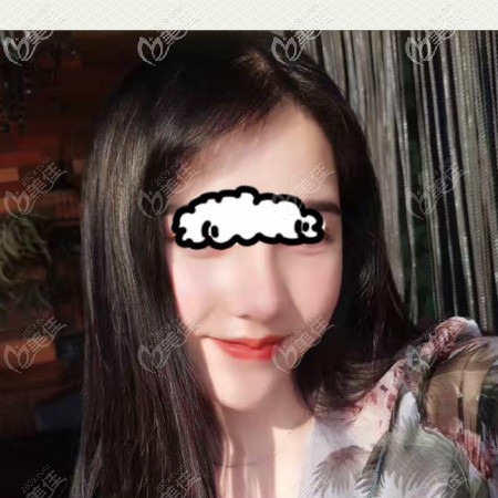 我在武漢壹加壹做過肋骨鼻綜合手術,李艷東做鼻子審美好價格也不貴