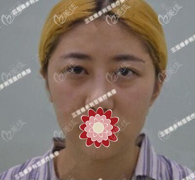 祛眼袋術(shù)前照 祛眼袋術(shù)前照