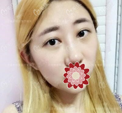 做外切去眼袋術(shù)后一周恢復(fù)情況 做外切去眼袋術(shù)后一周恢復(fù)情況