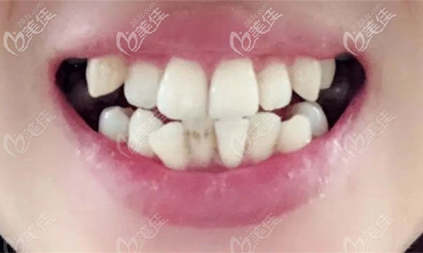 小姐姐在<!--<i data=20240703-sp></i>-->齒科整牙前的口內(nèi)照 小姐姐在<!--<i data=20240703-sp></i>-->齒科整牙前的口內(nèi)照