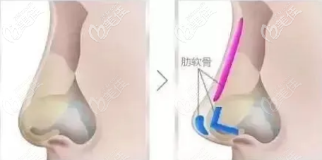 全肋骨隆鼻手術(shù)部位