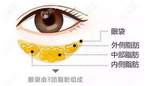 重度眼袋熱瑪吉無法改善