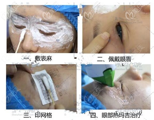 眼部熱瑪吉治療過程