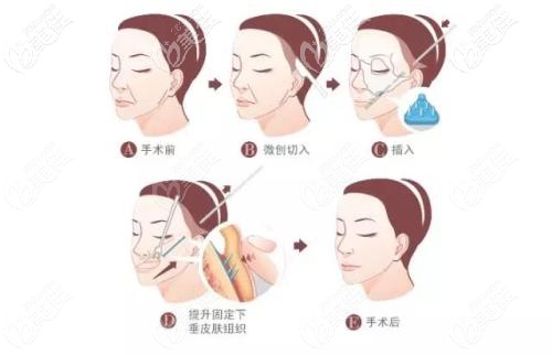 面部埋線的部位 面部埋線的部位