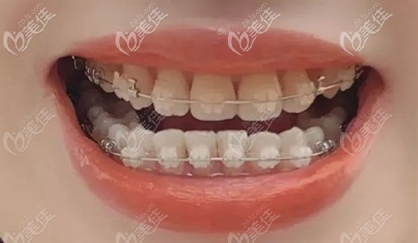 骨性齙牙在<!--<i data=20240703-sp></i>-->齒科矯正過程圖 骨性齙牙在<!--<i data=20240703-sp></i>-->齒科矯正過程圖
