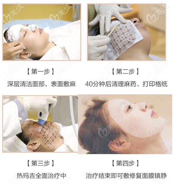 面部熱瑪吉治療過程圖