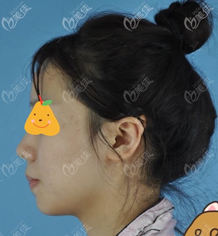 蘭州夢(mèng)想整形醫(yī)院臉部抽脂前 蘭州夢(mèng)想整形醫(yī)院臉部抽脂前