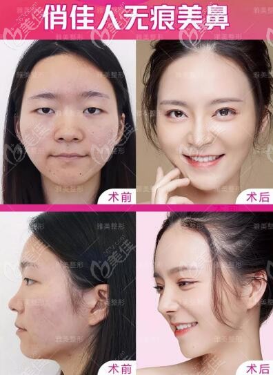 雅美俏佳人無(wú)痕美鼻真人案例