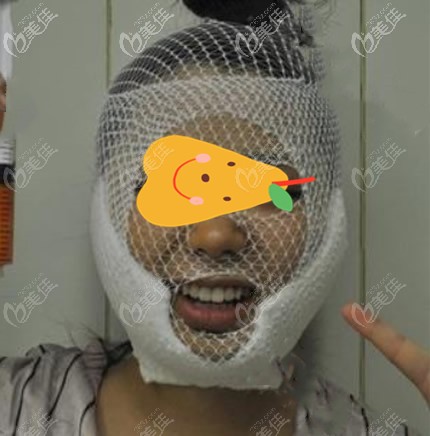 蘭州夢(mèng)想趙梅霞給我做面部吸脂第二天 蘭州夢(mèng)想趙梅霞給我做面部吸脂第二天