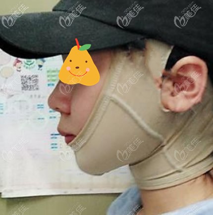 面部吸脂后帶頭套能預(yù)防凹凸不平 面部吸脂后帶頭套能預(yù)防凹凸不平