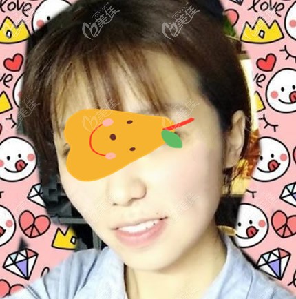 臉部抽脂7天<span style= 臉部抽脂7天<span style=