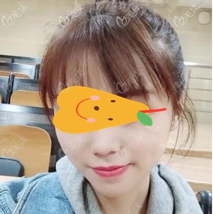 從我面部吸脂恢復(fù)一周過程圖片看,蘭州時光相伴整形醫(yī)院趙梅霞醫(yī)生臉部抽脂技術(shù)挺靠譜呀!