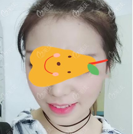 面部吸脂做完10天圖片 面部吸脂做完10天圖片