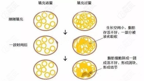 在術(shù)后脂肪填充過(guò)量會(huì)導(dǎo)致液化結(jié)節(jié)