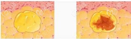 為啥脂肪填充后會(huì)出現(xiàn)液化