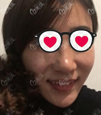 蘭州時光相伴黃國棟激光祛斑第三天<span style=