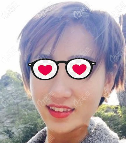 皮秒祛斑10天變化圖片