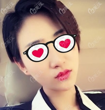 真沒想到!只在蘭州時光相伴做了兩次755蜂巢皮秒激光祛斑,臉上討厭的雀斑曬斑和小黑痣就消失了!