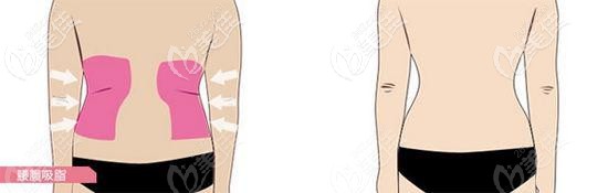 腰腹吸脂手術(shù)