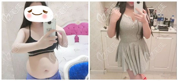 做腰腹吸脂術(shù)后1個月效果明顯