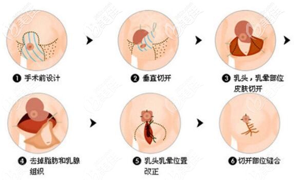 垂直雙蒂切開法縮胸介紹 垂直雙蒂切開法縮胸介紹