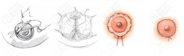 乳暈真皮帽雙環(huán)法縮胸原理和價(jià)格介紹 乳暈真皮帽雙環(huán)法縮胸原理和價(jià)格介紹