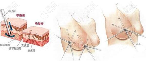 立體環(huán)吸吸脂法縮胸原理和價(jià)格介紹 立體環(huán)吸吸脂法縮胸原理和價(jià)格介紹