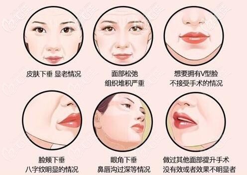 面部埋線提升適合人群 面部埋線提升適合人群