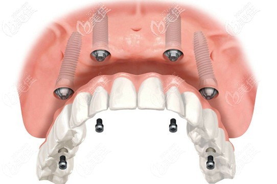 北京allon4全口種植牙費(fèi)用
