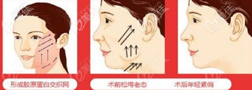 面部埋線提升的效果 面部埋線提升的效果