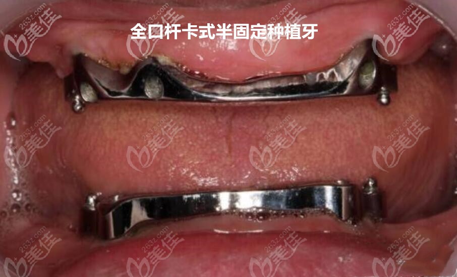 桿卡式半覆蓋式種植義齒 桿卡式半覆蓋式種植義齒