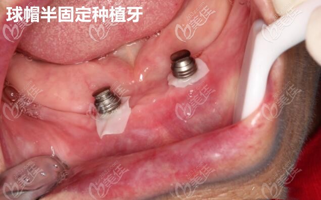 球帽半固定種植牙 球帽半固定種植牙