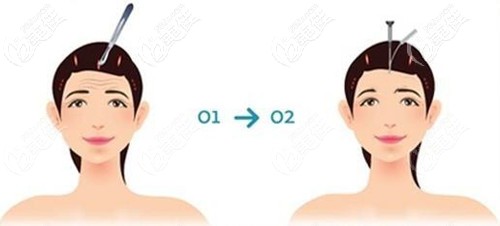 額頭抬頭紋能做拉皮手術(shù)嗎