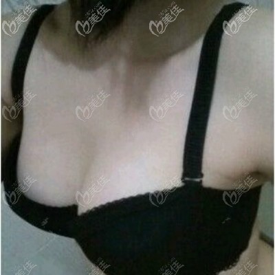 武漢卓美吳秀英隆胸案例:做法國(guó)ES伊思雅假體隆胸恢復(fù)十天效果 武漢卓美吳秀英隆胸案例:做法國(guó)ES伊思雅假體隆胸恢復(fù)十天效果