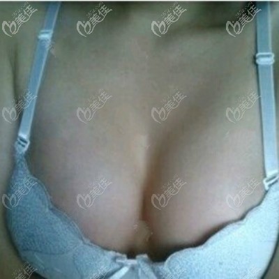 武漢卓美吳秀英隆胸案例圖片:我做的法國(guó)伊思雅高凸250cc型號(hào)