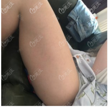 去深圳鵬程醫(yī)院做大腿抽脂術(shù)前照片 去深圳鵬程醫(yī)院做大腿抽脂術(shù)前照片