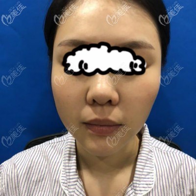 在亞韓做自體肋骨隆鼻前照片 在亞韓做自體肋骨隆鼻前照片