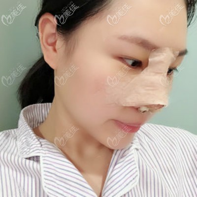 在武漢亞韓找鄧正輝醫(yī)生做自體肋骨隆鼻術(shù)后第3天 在武漢亞韓找鄧正輝醫(yī)生做自體肋骨隆鼻術(shù)后第3天