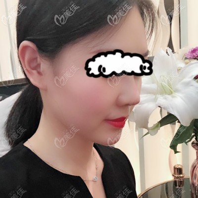 花3萬(wàn)在亞韓做自體骨隆鼻10天<span style= 花3萬(wàn)在亞韓做自體骨隆鼻10天<span style=