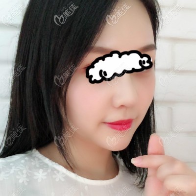 武漢亞韓鄧正輝醫(yī)生為我做自體肋骨隆鼻45天<span style= 武漢亞韓鄧正輝醫(yī)生為我做自體肋骨隆鼻45天<span style=